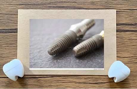 インプラント｜すなやま歯科